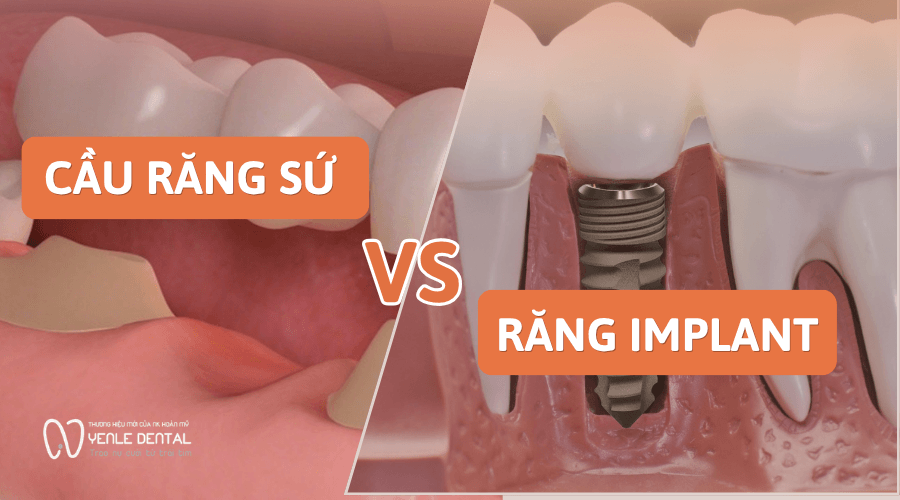 cầu răng sứ hay răng Implant